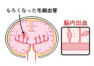 脳出血の4つの症状とは 前兆と治療法を紹介する Mamotte